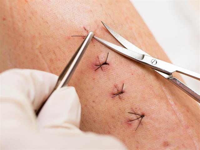 Removal of Stitches and Staples for Health Care Assistants